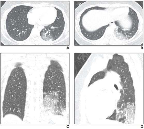 Pediatric coronavirus disease (COVID-19) x-ray, CT in review of new lung disorders