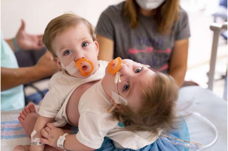 'Power of positive': Michigan conjoined twins separated
