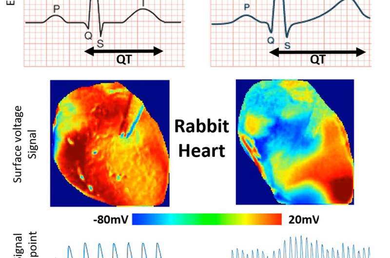 Study shows hydroxychloroquine's harmful effects on heart rhythm