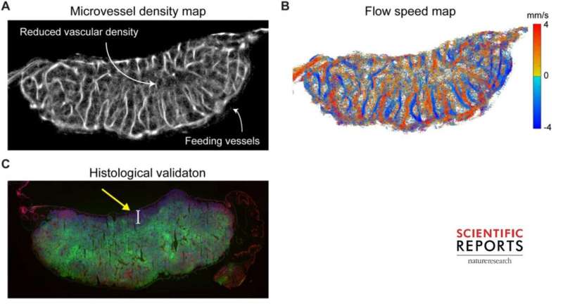 Using ultrasound localization microscopy to detect oxygen levels in tissues