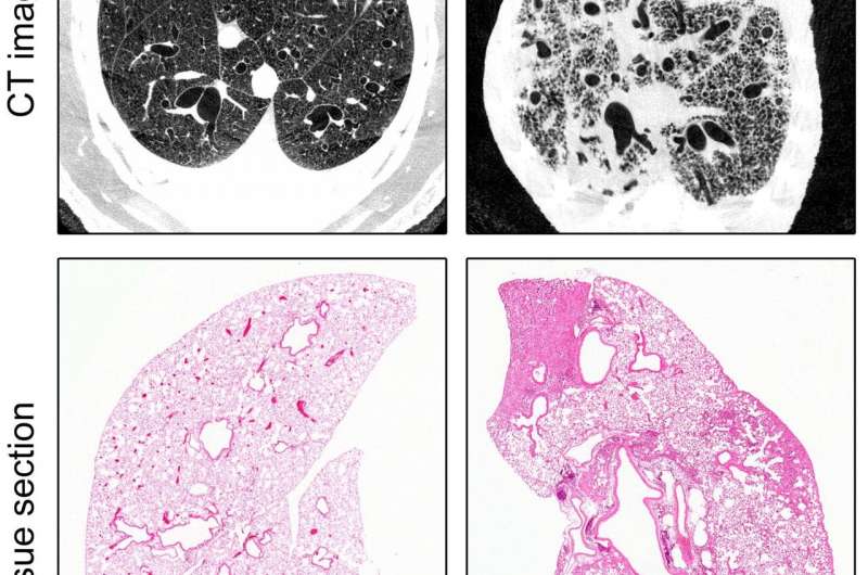 Researchers identify key mechanisms involved in pulmonary fibrosis development