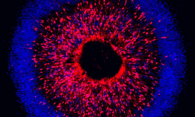 Researchers model human stem cells to identify degeneration in glaucoma