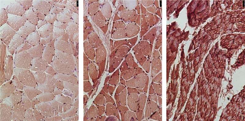 Researchers identify therapeutic targets to prevent cancer-associated muscle loss