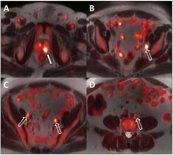 18F-Fluciclovine PET/MRI for prostate cancer staging, androgen deprivation evaluation