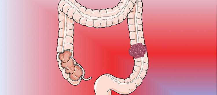 Colorectal cancer treatment: The winning combinations
