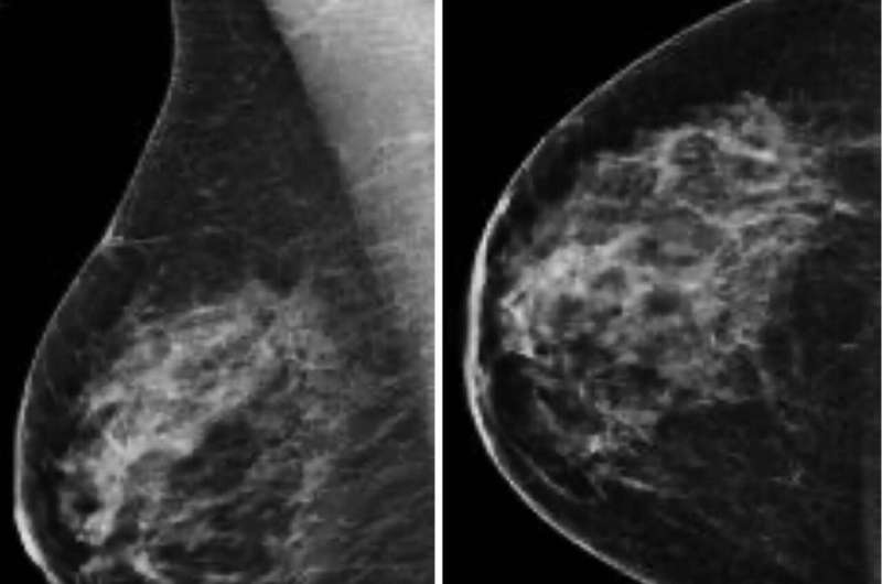 Digital breast tomosynthesis improves invasive cancer detection