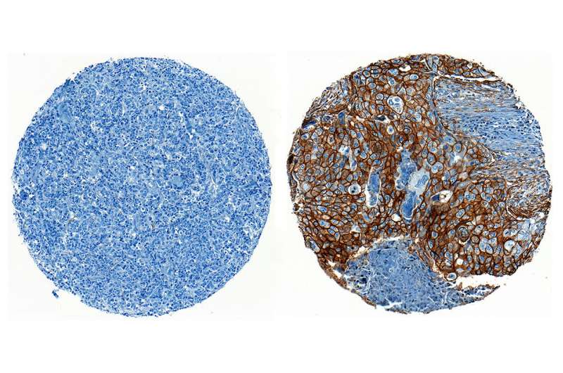 Discovery about how cancer cells evade immune defenses inspires new treatment approach
