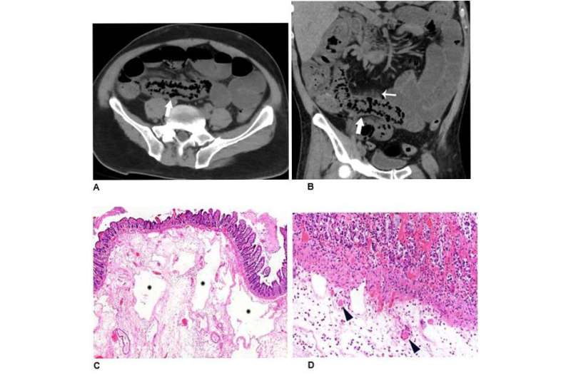 Imaging reveals bowel abnormalities in patients with COVID-19