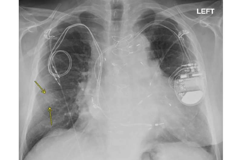 MRI safely performed in patients with pacemakers and ICDs