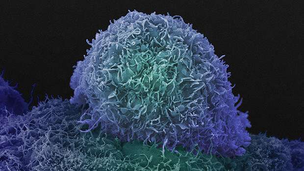 Prostate cancer treatment approved in England