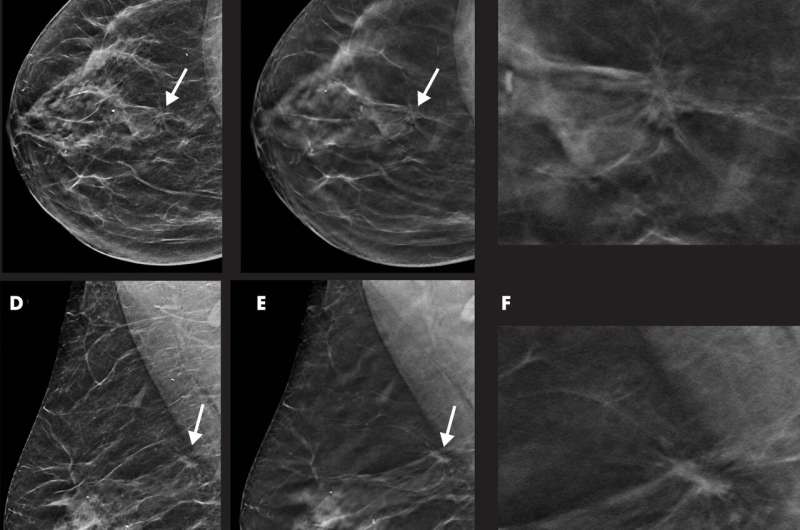 Tomosynthesis with synthetic mammography improves breast cancer detection