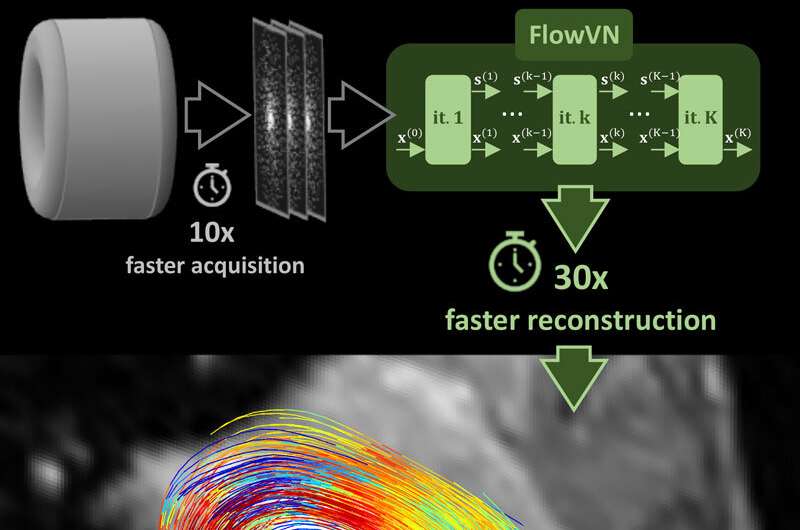 Artificial intelligence accelerates blood flow MRI