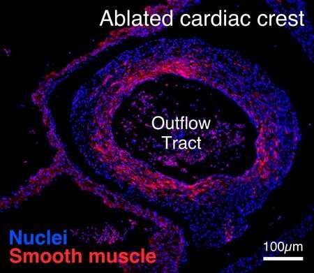 Understanding congenital heart defects, one chicken at a time