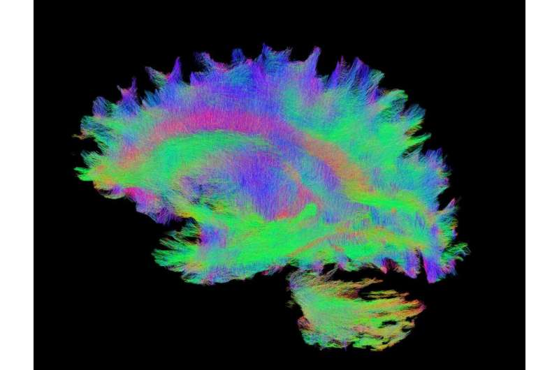 Big data analysis suggests role of brain connectivity in epilepsy-related atrophy