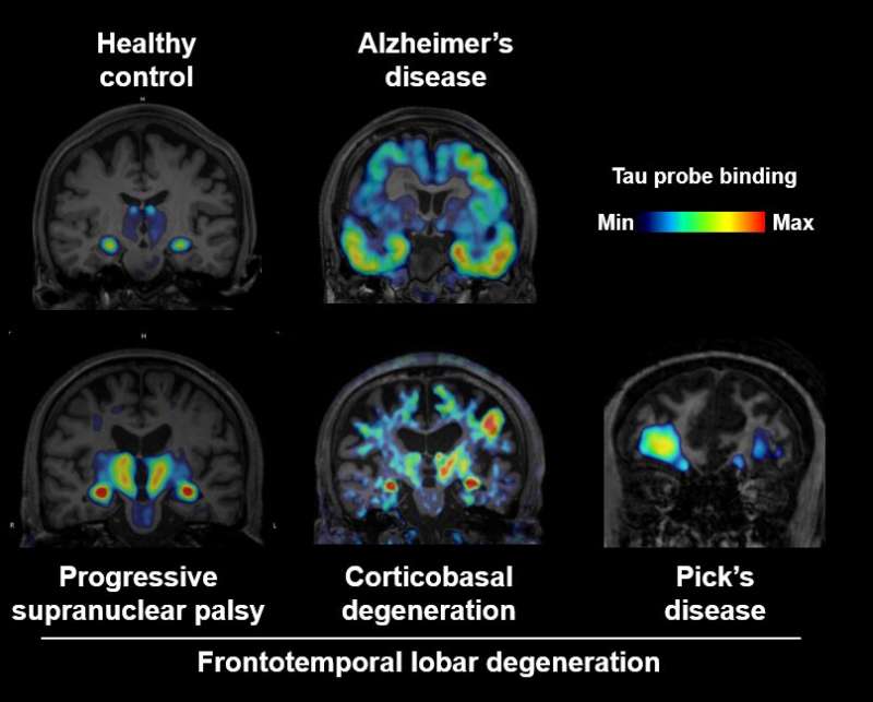 Brain imaging of tau protein in patients with various forms of dementia