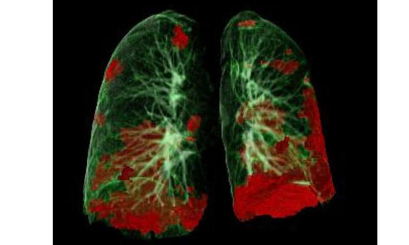 COVID-19 patients suffer long-term lung and heart damage but it can improve with time