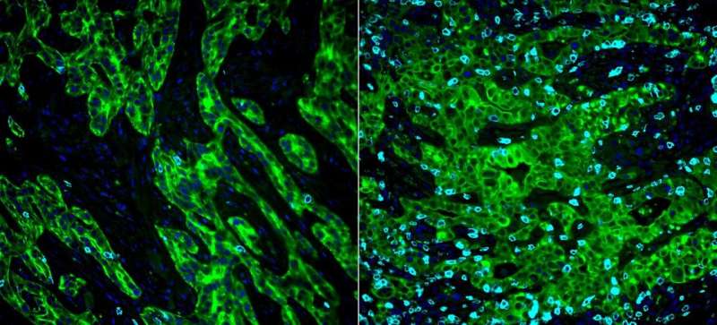 Pancreatic cancer cells hijack basic cell mechanism to evade immunotherapy