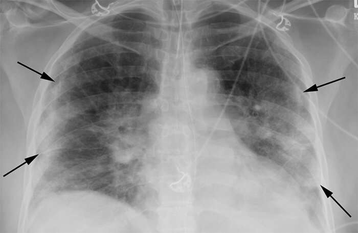 放射科医生发现胸部X射线高度预测的Covid-19