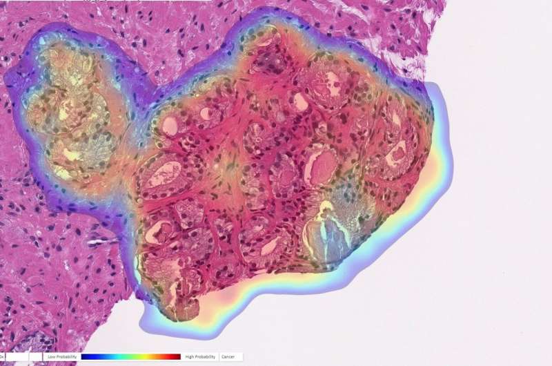 Artificial intelligence identifies prostate cancer with near-perfect accuracy