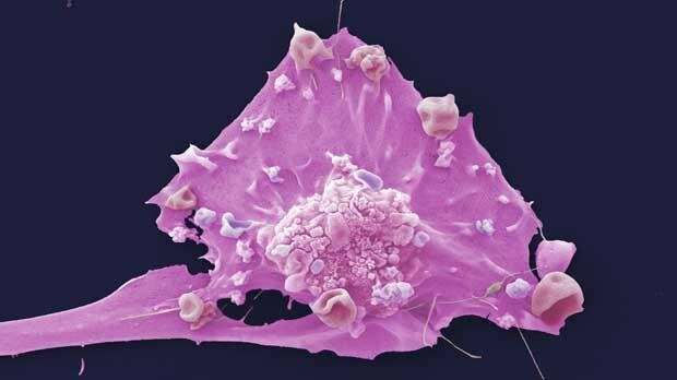 Immunotherapy for triple-negative breast cancer approved for NHS in England 