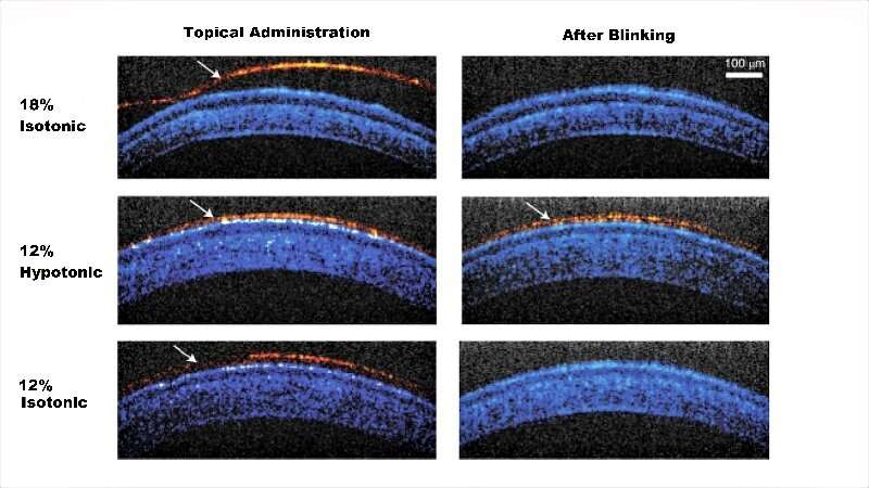 Temperature-sensitive, longer-lasting eyedrops may mean fewer applications, better therapy
