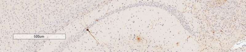 Build-up of brain proteins affects genes in Alzheimer's disease