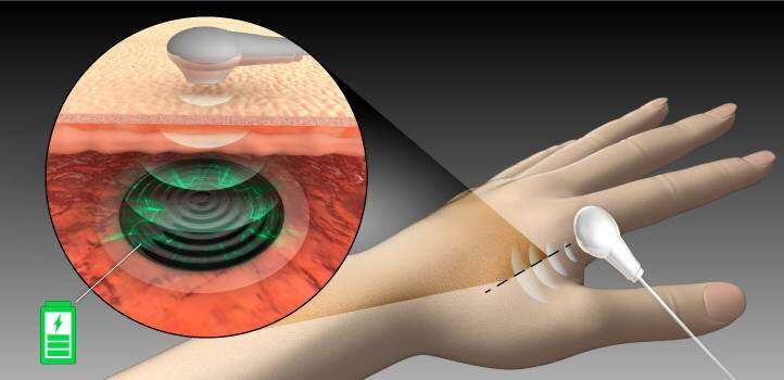 Remotely charge batteries through flesh for permanent implantable medical devices