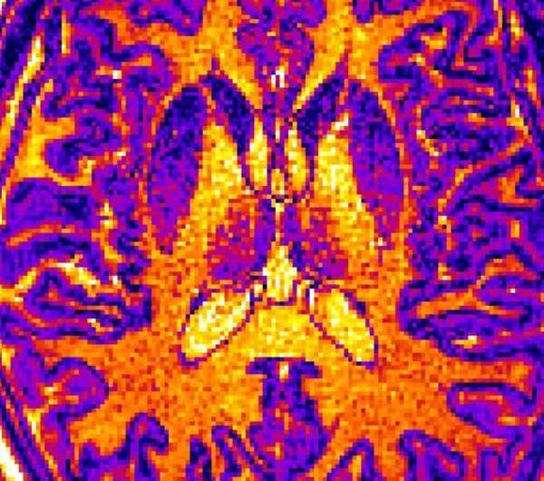 Computer IDs differences in brains of patients with schizophrenia or autism