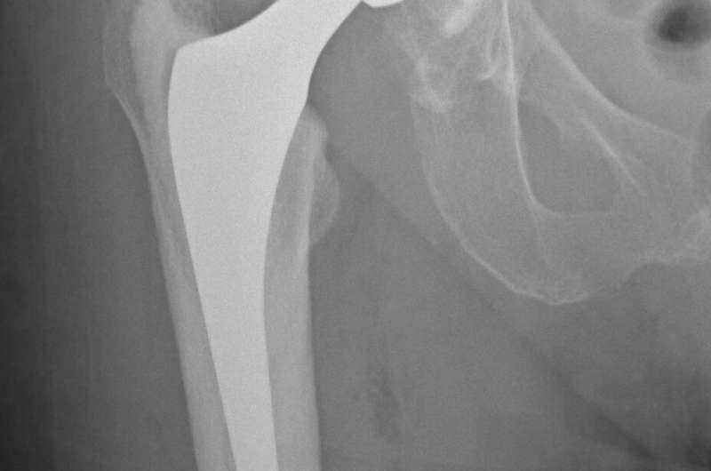 Implant choice more important than surgeon skill for hip replacement success
