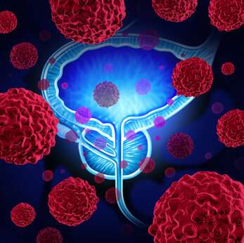 Prostate cancer: µ-crystallin (CRYM) protein inhibits tumour growth