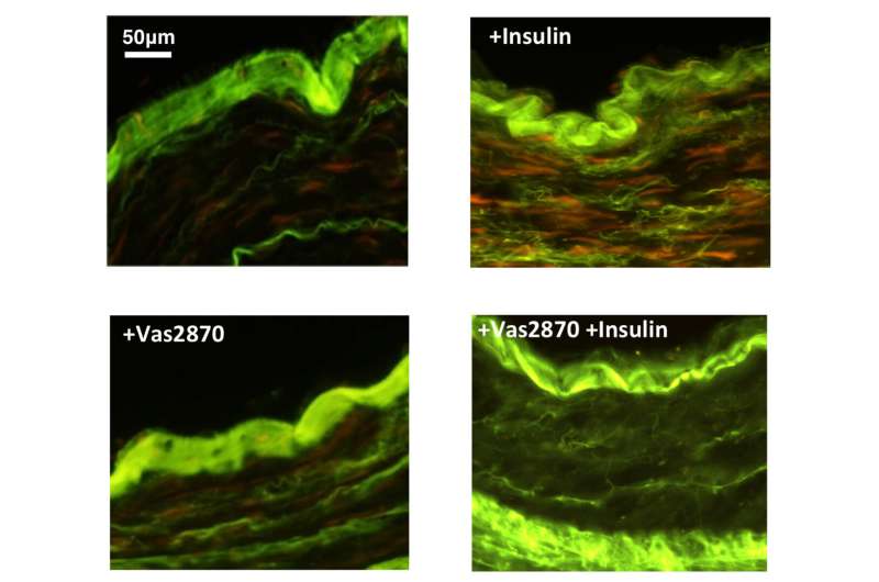 A new strategy to counter insulin damage in coronary artery disease