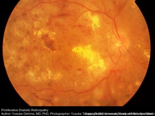 Researchers use genomics to identify diabetic retinopathy factors