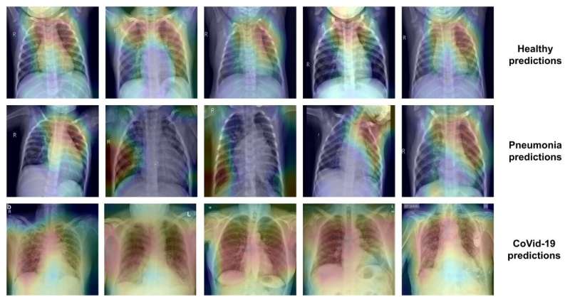 Researchers develop a new system that can distinguish pneumonia from COVID-10 from chest X-rays