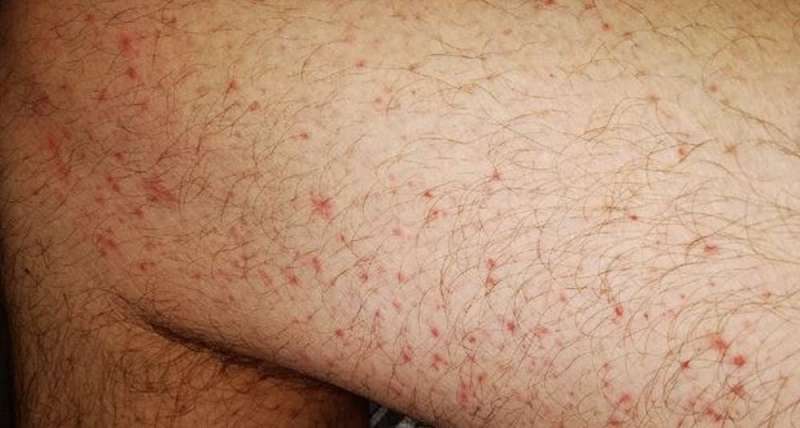 8 ways the coronavirus can affect your skin, from COVID toes, to rashes and hair loss