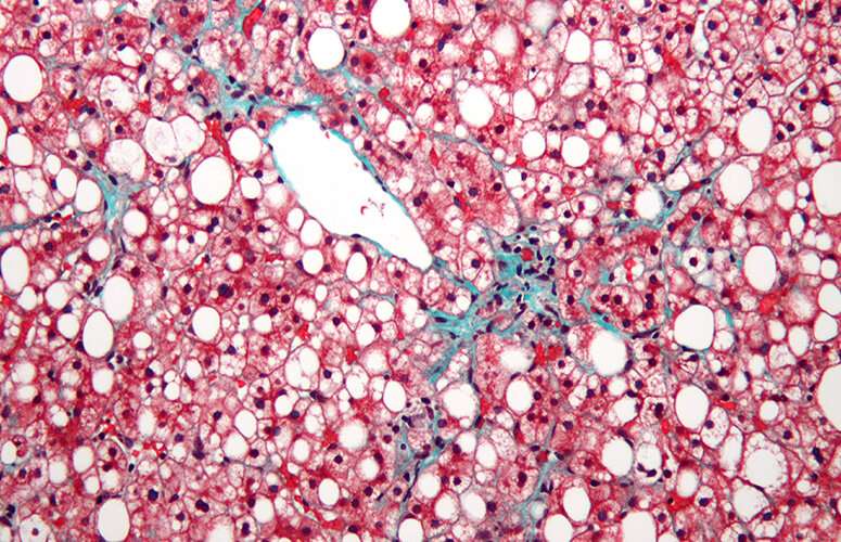 Researchers develop new drugs for treating polycystic hepatorena