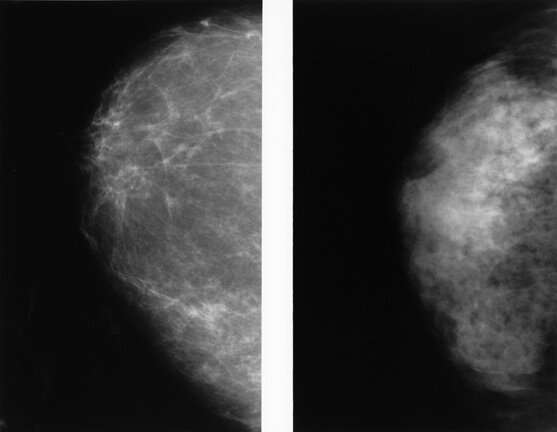 Abbreviated MRI outperforms 3D mammograms at finding cancer in dense breasts