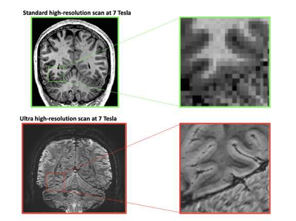 Advanced, high-res MRI scans reveal link between cognitive abilities and ‘tree ring’ layers in the brain
