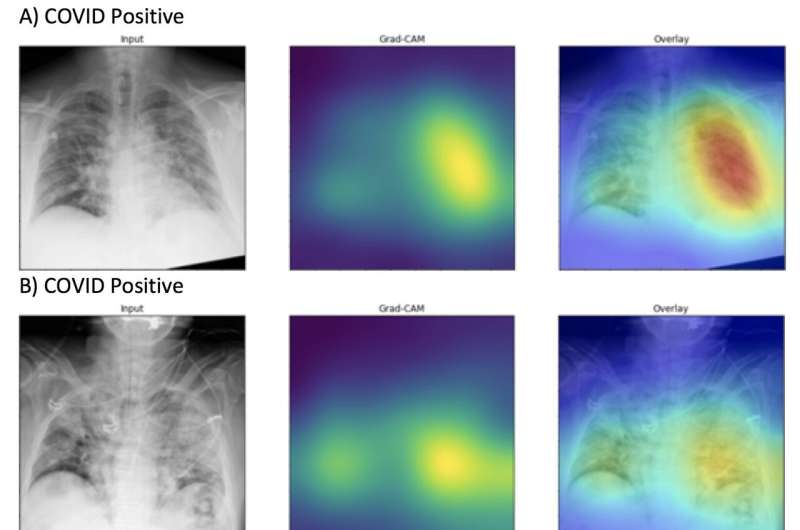 AI detects COVID-19 on chest x-rays with accuracy and speed