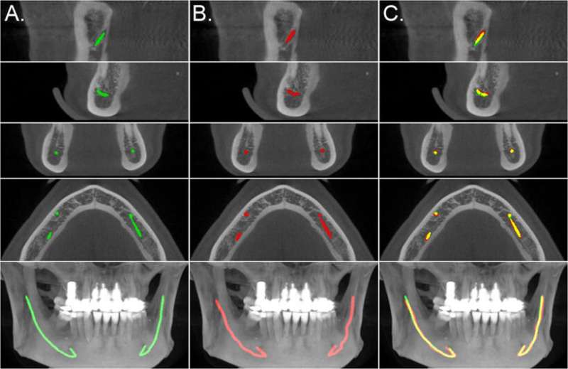 AI makes dentists’ work easier – new model helps localise the mandibular canals