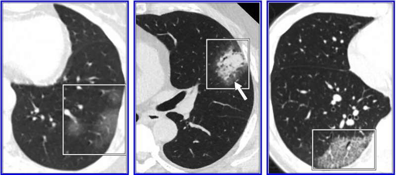 AJR对COVID-19研究的回顾警告不要用胸部CT诊断冠状病毒