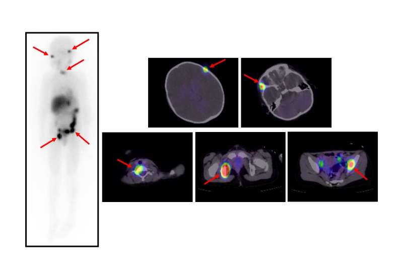 神经母细胞瘤儿童的新型放射性同位素疗法