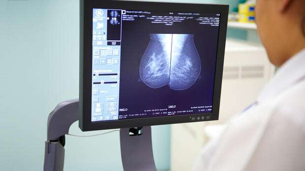 Artificial intelligence could help breast screening save more lives