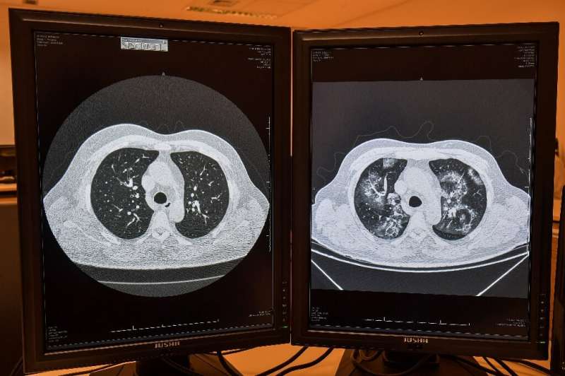 A tomography image of the same patient showing a healthy lungs (L) and lungs affected by COVID-19 (R) at the University of Sao P