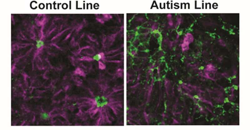 Autistic people's nerve cells differ before birth