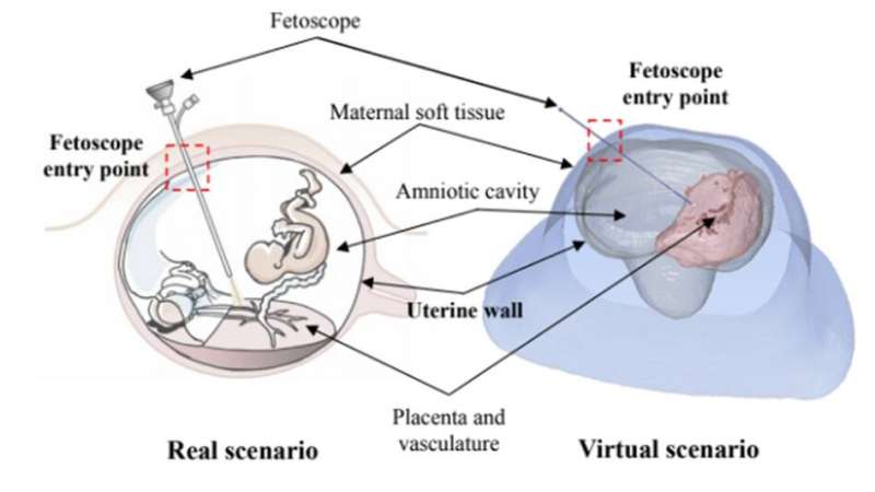 BCN MedTech presents an automatic method to detect and segment the intrauterine cavity