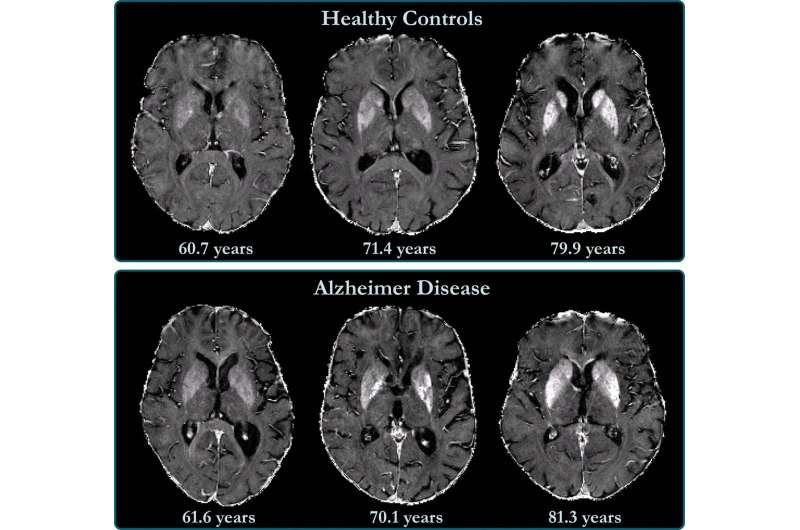 Brain iron accumulation linked to cognitive decline in Alzheimer's patients