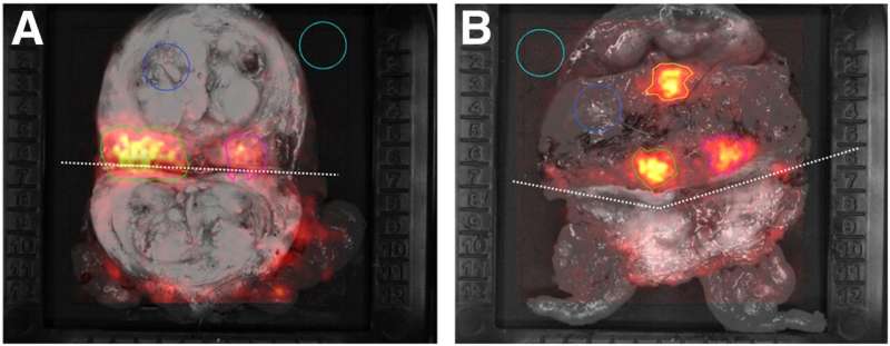 Cerenkov luminescence imaging identifies surgical margin status in radical prostatectomy