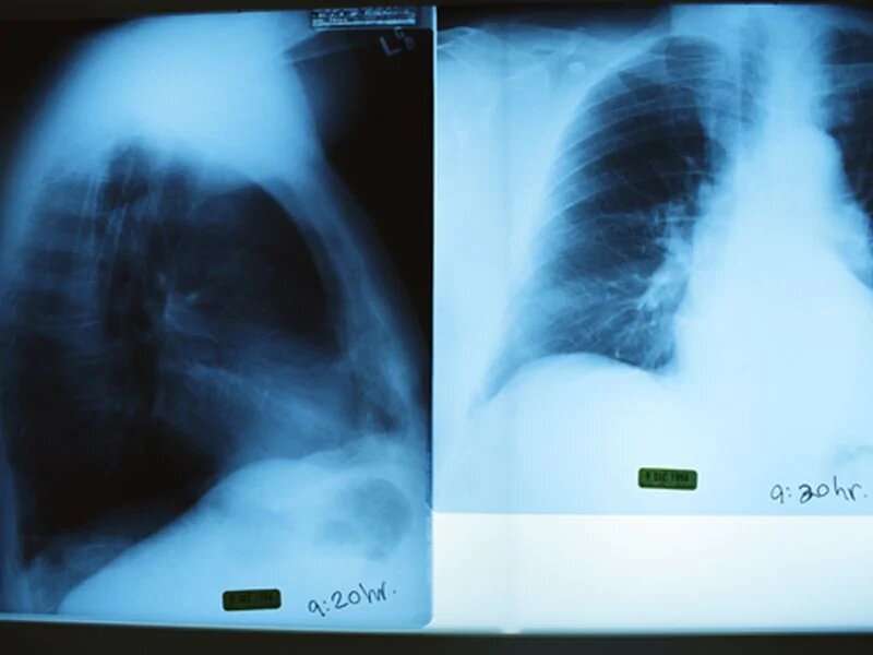 胸部X射线调查结果正常，许多确诊的Covid-19例