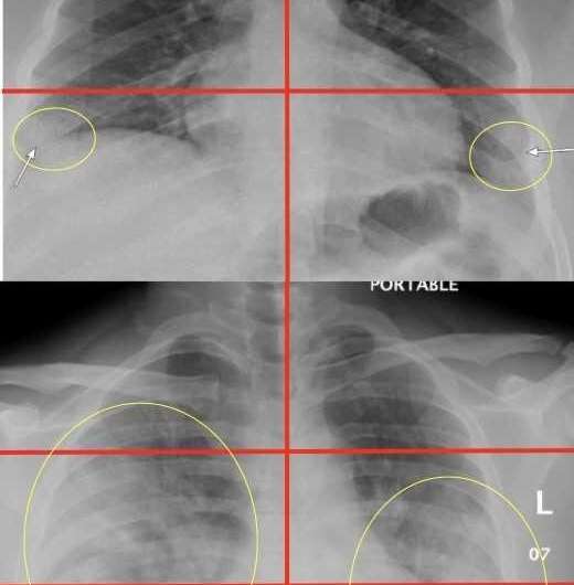 Chest X-rays in emergency rooms can help predict severity of COVID-19 in young and middle-aged adults
