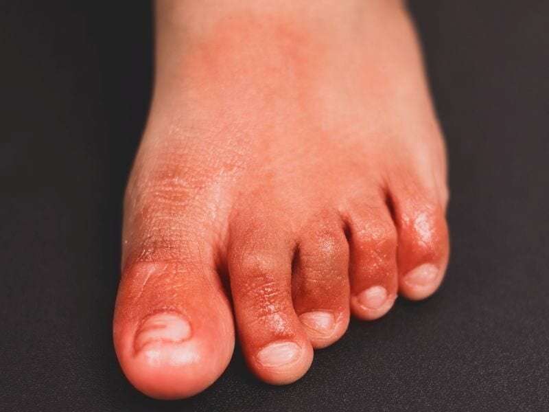 Chilblains in recent case series not tied to COVID-19 infection
